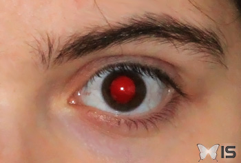 La lumière renvoyée par les vaisseaux sanguins de la choroïde est visible à travers la pupille