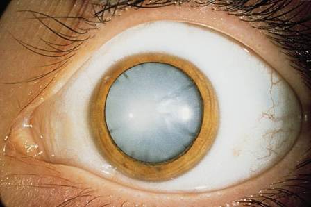 Oeil atteint de cataracte : le cristallin a perdu sa transparence 