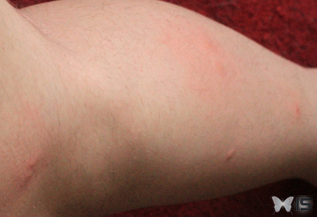Multiples piqûres de moustique sur une jambe